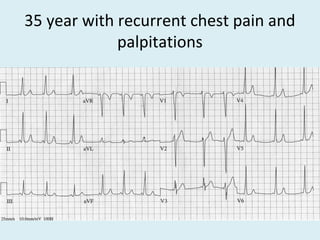35 year with recurrent chest pain and
palpitations
 