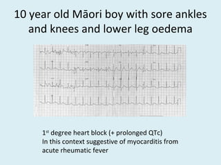 10 year old Māori boy with sore ankles
and knees and lower leg oedema
1st
degree heart block (+ prolonged QTc)
In this context suggestive of myocarditis from
acute rheumatic fever
 