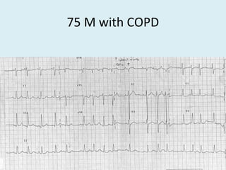 75 M with COPD
 