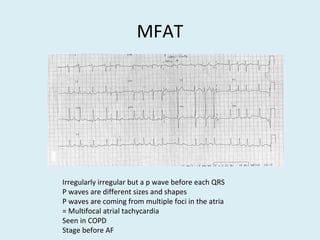 MFAT
Irregularly irregular but a p wave before each QRS
P waves are different sizes and shapes
P waves are coming from multiple foci in the atria
= Multifocal atrial tachycardia
Seen in COPD
Stage before AF
 