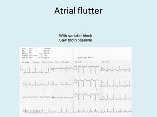 Atrial flutter
With variable block
Saw tooth baseline
 