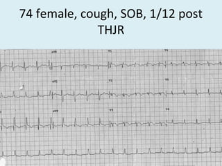 74 female, cough, SOB, 1/12 post
THJR
 