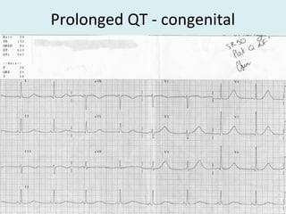 Prolonged QT - congenital
 
