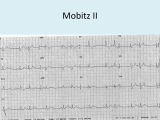 Mobitz II
 