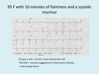 95 F with 10 minutes of faintness and a systolic
murmur
R wave in aVL > 11mm is one criterion for LVH
This ECG + murmur suggestive of critical aortic stenosis
= does not go home
 