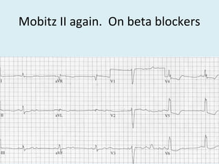 Mobitz II again. On beta blockers
 