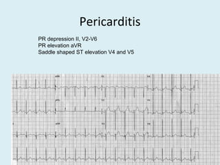 Pericarditis
PR depression II, V2-V6
PR elevation aVR
Saddle shaped ST elevation V4 and V5
 
