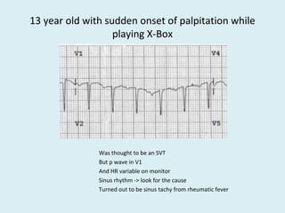 13 year old with sudden onset of palpitation while
playing X-Box
Was thought to be an SVT
But p wave in V1
And HR variable on monitor
Sinus rhythm -> look for the cause
Turned out to be sinus tachy from rheumatic fever
 