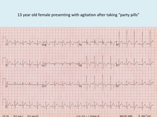 13 year old female presenting with agitation after taking “party pills”
 