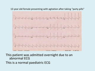 13 year old female presenting with agitation after taking “party pills”
This patient was admitted overnight due to an
abnormal ECG
This is a normal paediatric ECG
 