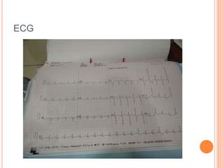 ECG
 