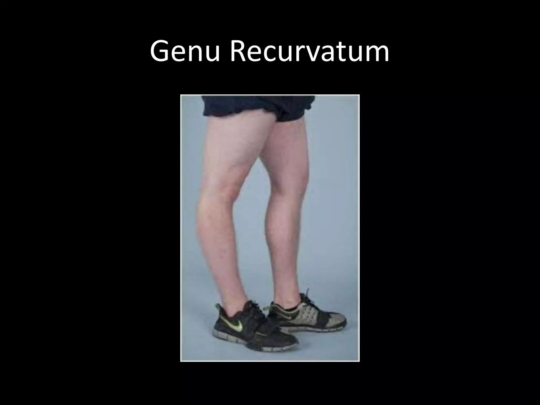 Genu Recurvatum
 