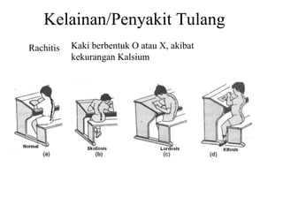 Kelainan/Penyakit Tulang Rachitis Kaki berbentuk O atau X, akibat kekurangan Kalsium  