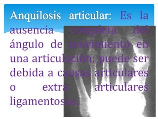 Es la
ausencia completa del
ángulo de movimiento en
una articulación; puede ser
debida a causas articulares
o extra articulares
ligamentosas.
 