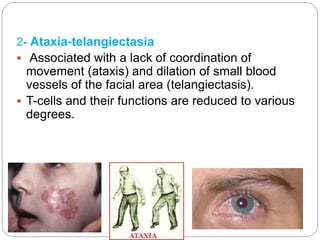 2- Ataxia-telangiectasia
 Associated with a lack of coordination of
movement (ataxis) and dilation of small blood
vessels of the facial area (telangiectasis).
 T-cells and their functions are reduced to various
degrees.
 
