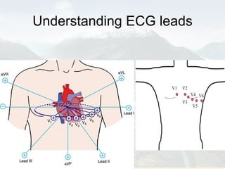 Understanding ECG leads 