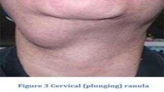 Pediatric Ranula Ranula | PPTX