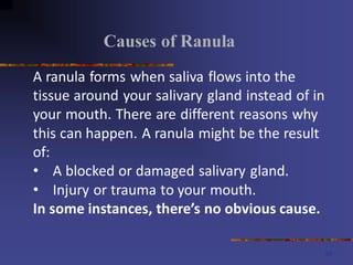 Ranula.Sustemic Surgery,Dental Surgery pdf | PDF