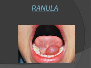 What Are Ranula Ranula and its examination -surgery.pptx