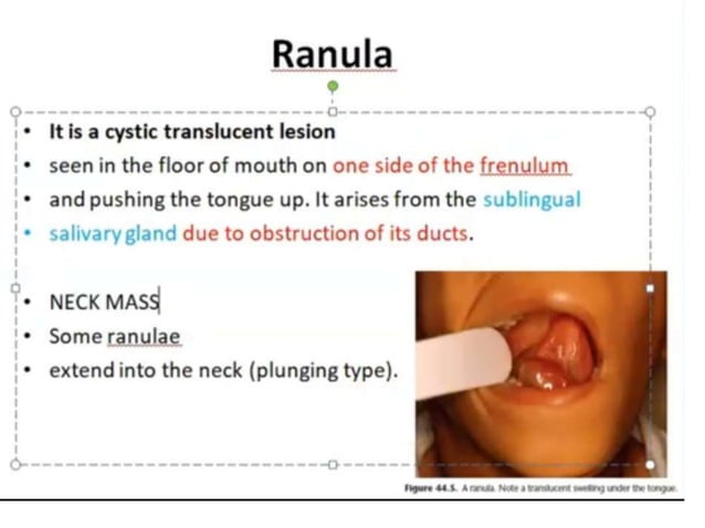 What Are Ranula Ranula and plunging ranula | PPTX