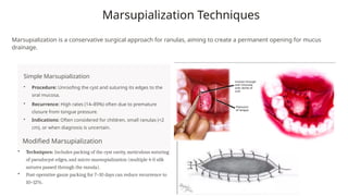 Marspulization ranula_clinical features and management.pptx