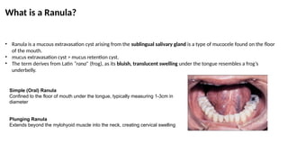 ranula_clinical features and management.pptx