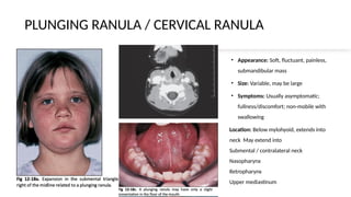 ranula_clinical features and management.pptx