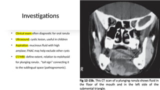 ranula_clinical features and management.pptx
