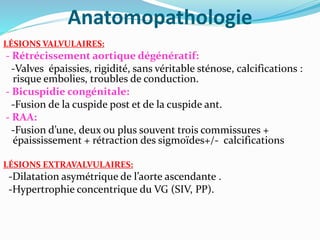 Anatomopathologie
LÉSIONS VALVULAIRES:
- Rétrécissement aortique dégénératif:
-Valves épaissies, rigidité, sans véritable sténose, calcifications :
risque embolies, troubles de conduction.
- Bicuspidie congénitale:
-Fusion de la cuspide post et de la cuspide ant.
- RAA:
-Fusion d’une, deux ou plus souvent trois commissures +
épaississement + rétraction des sigmoïdes+/- calcifications
LÉSIONS EXTRAVALVULAIRES:
-Dilatation asymétrique de l’aorte ascendante .
-Hypertrophie concentrique du VG (SIV, PP).
 