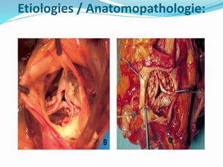 Etiologies / Anatomopathologie:
 