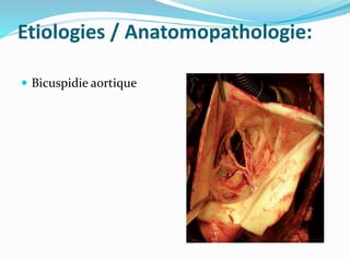 Etiologies / Anatomopathologie:
 Bicuspidie aortique
 