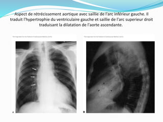 Aspect de rétrécissement aortique avec saillie de l'arc inférieur gauche. Il
traduit l'hypertrophie du ventriculaire gauche et saillie de l'arc superieur droit
traduisant la dilatation de l'aorte ascendante.
 