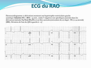 ECG du RAO
Électrocardiogramme 12 dérivations montrant une hypertrophie ventriculaire gauche
systolique (Sokolow SV1 + RV6 = 45 mm , ondes T négatives non spécifiques associées dans les
dérivations latérales V5-V6 et DI aVL) et un bloc auriculoventriculaire du 1er degré : PR à 0,24 seconde
(DII). Déviation de l’axe du QRS à gauche à - 15°.
 