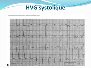 HVG systolique
 