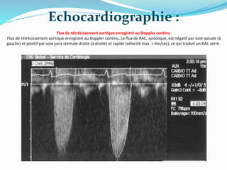 Flux de rétrécissement aortique enregistré au Doppler continu
Flux de rétrécissement aortique enregistré au Doppler continu. Le flux de RAC, systolique, est négatif par voie apicale (à
gauche) et positif par voie para sternale droite (à droite) et rapide (vélocité max. > 4m/sec), ce qui traduit un RAC serré.
Echocardiographie :
 