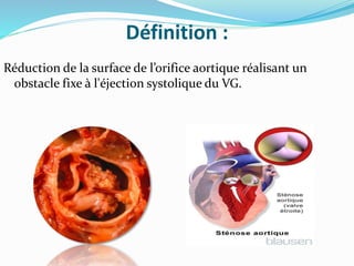 Définition :
Réduction de la surface de l’orifice aortique réalisant un
obstacle fixe à l'éjection systolique du VG.
 
