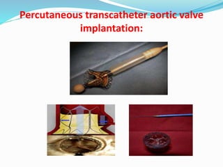 Percutaneous transcatheter aortic valve
implantation:
 