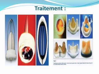 Traitement :
 