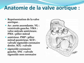 Anatomie de la valve aortique :
 Représentation de la valve
aortique .
 Ao : aorte ascendante. VG :
ventricule gauche. VMA :
valve mitrale antérieure.
PMA : pilier mitral
 antérieur. PMP : pilier
mitral postérieur. SCD :
valvule sigmoïde coronaire
droite. SCG : valvule
 sigmoïde coronaire
gauche. SNC : valvule
sigmoïde non coronaire
 