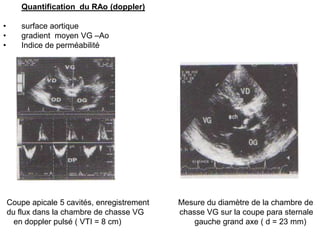Quantification du RAo (doppler)

•       surface aortique
•       gradient moyen VG –Ao
•       Indice de perméabilité




    Coupe apicale 5 cavités, enregistrement   Mesure du diamètre de la chambre de
    du flux dans la chambre de chasse VG      chasse VG sur la coupe para sternale
      en doppler pulsé ( VTI = 8 cm)              gauche grand axe ( d = 23 mm)
 