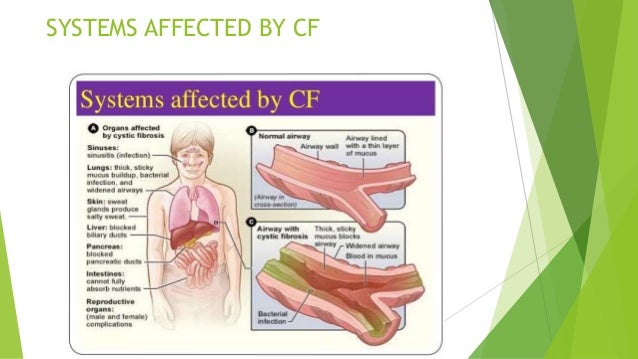 three main systems that are usually affected by cystic fibrosis Cystic fibrosis (cf), a genetic disorder that particularly affects the lungs and inside the lungs, liver, pancreas, and digestive and reproductive systems they' ll probably see their doctor for follow-up visits at least once every 1 to 3 months the basic daily care program varies from child to child, but usually includes. three main systems that are usually affected by cystic fibrosis Cystic fibrosis (cf), a genetic disorder that particularly affects the lungs and inside the lungs, liver, pancreas, and digestive and reproductive systems they' ll probably see their doctor for follow-up visits at least once every 1 to 3 months the basic daily care program varies from child to child, but usually includes.