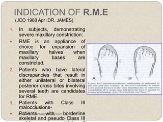 INDICATION OF R.M.E
(JCO 1968 Apr ;DR. JAMES)
1. In subjects, demonstrating
severe maxillary constriction:
 RME is an appliance of
choice for expansion of
maxillary halves when
maxillary bases are
constricted.
2. Patients who have lateral
discrepancies that result in
either unilateral or bilateral
posterior cross bites involving
several teeth are candidates
for RME.
3. Patients with Class III
malocclusions-
 Patients with borderline
skeletal and pseudo Class III
www.indiandentalacademy.com
 