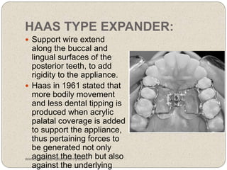 HAAS TYPE EXPANDER:
 Support wire extend
along the buccal and
lingual surfaces of the
posterior teeth, to add
rigidity to the appliance.
 Haas in 1961 stated that
more bodily movement
and less dental tipping is
produced when acrylic
palatal coverage is added
to support the appliance,
thus pertaining forces to
be generated not only
against the teeth but also
against the underlying
www.indiandentalacademy.com
 