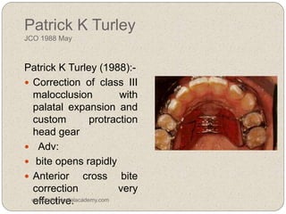 Patrick K Turley
JCO 1988 May
Patrick K Turley (1988):-
 Correction of class III
malocclusion with
palatal expansion and
custom protraction
head gear
 Adv:
 bite opens rapidly
 Anterior cross bite
correction very
effective.www.indiandentalacademy.com
 