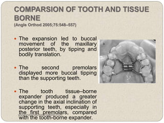 COMPARSION OF TOOTH AND TISSUE
BORNE
(Angle Orthod 2005;75:548–557)
 The expansion led to buccal
movement of the maxillary
posterior teeth, by tipping and
bodily translation.
 The second premolars
displayed more buccal tipping
than the supporting teeth.
 The tooth tissue–borne
expander produced a greater
change in the axial inclination of
supporting teeth, especially in
the first premolars, compared
with the tooth-borne expander.
www.indiandentalacademy.com
 