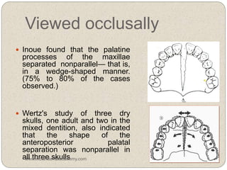 Viewed occlusally
 Inoue found that the palatine
processes of the maxillae
separated nonparallel— that is,
in a wedge-shaped manner.
(75% to 80% of the cases
observed.)
 Wertz's study of three dry
skulls, one adult and two in the
mixed dentition, also indicated
that the shape of the
anteroposterior palatal
separation was nonparallel in
all three skullswww.indiandentalacademy.com
 