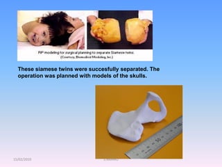 15/02/2010 S.AARNIO
These siamese twins were succesfully separated. The
operation was planned with models of the skulls.
 