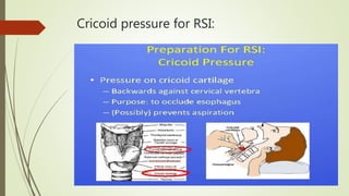 Cricoid pressure for RSI:
 