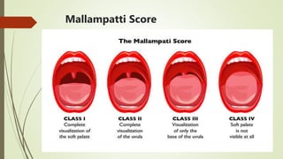 Mallampatti Score
 