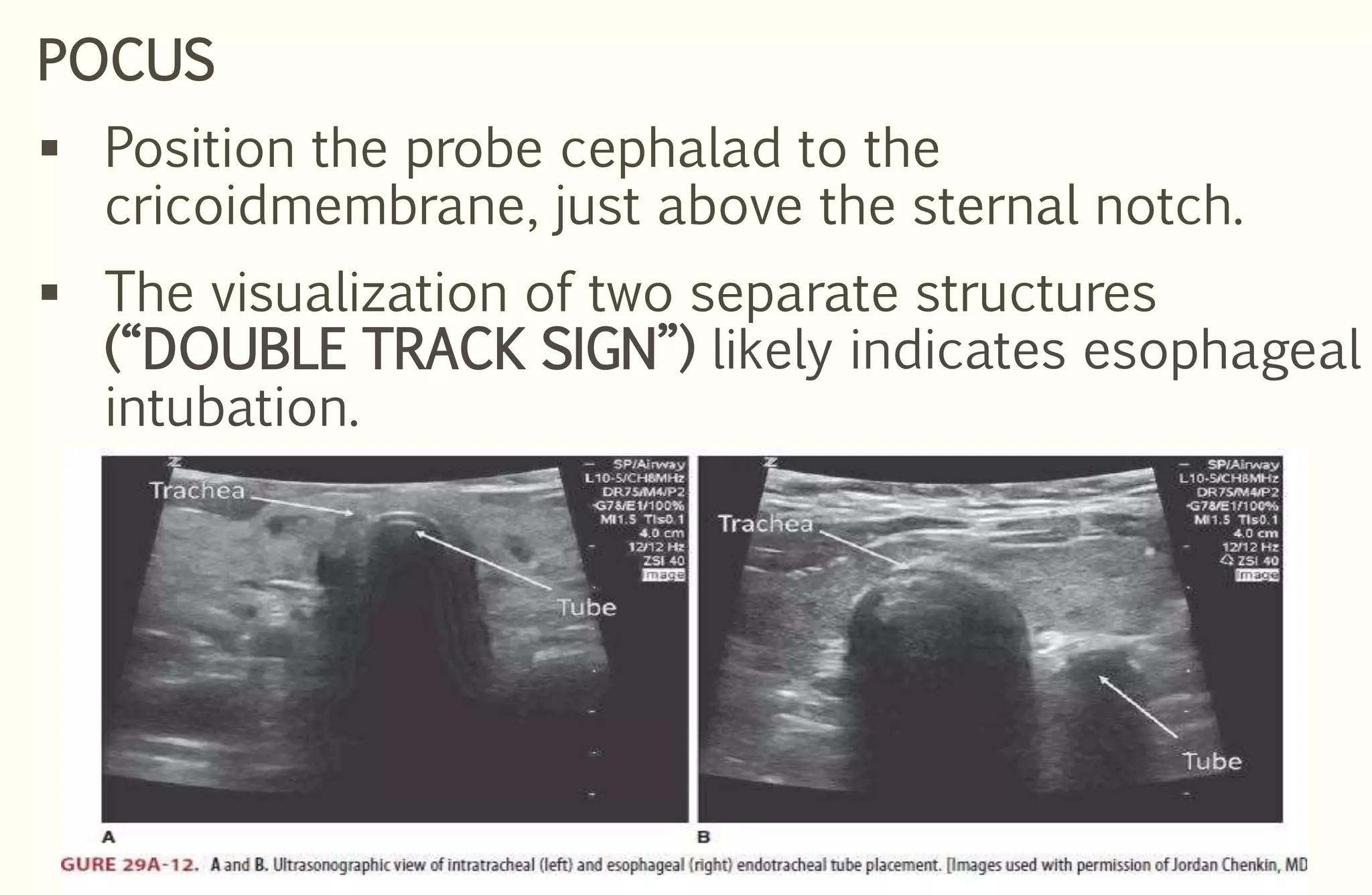 POCUS
 Position the probe cephalad to the
cricoidmembrane, just above the sternal notch.
 The visualization of two separate structures
(“DOUBLE TRACK SIGN”) likely indicates esophageal
intubation.
 